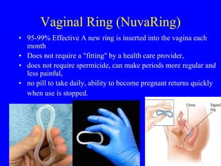 Vaginal Ring (NuvaRing) 
• 95-99% Effective A new ring is inserted into the vagina each 
month 
• Does not require a "fitting" by a health care provider, 
• does not require spermicide, can make periods more regular and 
less painful, 
• no pill to take daily, ability to become pregnant returns quickly 
when use is stopped. 
 