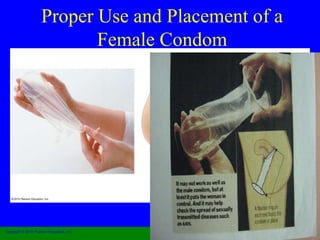 Proper Use and Placement of a 
Female Condom 
Copyright © 2010 Pearson Education, Inc. 
 