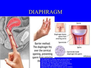 DIAPHRAGM 
The diaphragm is a flexible rubber cup that is filled with 
spermicide and self-inserted over the cervix prior to 
intercourse. The device is left in place several hours 
after intercourse. The diaphragm is a prescribed device 
fitted by a health care professional and is more 
expensive than other barrier methods, such as condoms 
 