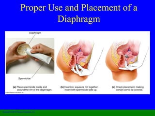 Proper Use and Placement of a 
Diaphragm 
Copyright © 2010 Pearson Education, Inc. 
 