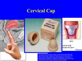 Cervical Cap 
The cervical cap is a flexible rubber cup-like device that is filled with 
spermicide and self-inserted over the cervix prior to intercourse. The 
device is left in place several hours after intercourse. The cap is a 
prescribed device fitted by a health care professional and can be more 
expensive than other barrier methods, such as condoms. 
 