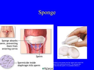 Sponge 
The sponge is inserted by the woman into the vagina and covers the 
cervix blocking sperm from entering the cervix. The sponge also 
contains a spermicide that kills sperm. It is available without a 
prescription 
 