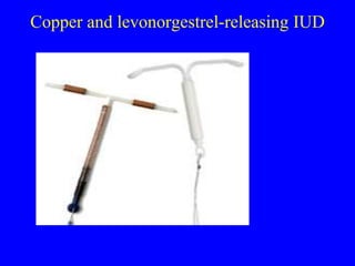 Copper and levonorgestrel-releasing IUD 
 