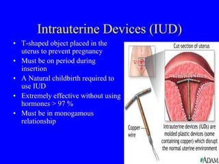 Intrauterine Devices (IUD) 
• T-shaped object placed in the 
uterus to prevent pregnancy 
• Must be on period during 
insertion 
• A Natural childbirth required to 
use IUD 
• Extremely effective without using 
hormones > 97 % 
• Must be in monogamous 
relationship 
 