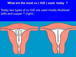 What are the most cu ( IUD ) used today ? 
Today two types of cu IUD are used mostly Multiload 
(left) and cupper T (right) : 
 
