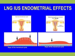 LNG IUS ENDOMETRIAL EFFECTS 
Ovulation 
Ovulation 
Menstruation 
Days of the menstrual cycle Days of the menstrual cycle 
 