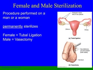 Female and Male Sterilization 
Procedure performed on a 
man or a woman 
permanently sterilizes 
Female = Tubal Ligation 
Male = Vasectomy 
Copyright © 2010 Pearson Education, Inc. 
 