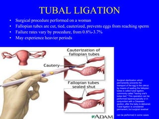 TUBAL LIGATION 
• Surgical procedure performed on a woman 
• Fallopian tubes are cut, tied, cauterized, prevents eggs from reaching sperm 
• Failure rates vary by procedure, from 0.8%-3.7% 
• May experience heavier periods 
Surgical sterilization which 
permanently prevents the 
transport of the egg to the uterus 
by means of sealing the fallopian 
tubes is called tubal ligation, 
commonly called "having one's 
tubes tied." This operation can be 
performed laparoscopically or in 
conjunction with a Cesarean 
section, after the baby is delivered. 
Tubal ligation is considered 
permanent, but surgical reversal 
can be performed in some cases 
 