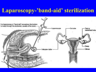 Laparoscopy-’band-aid’ sterilization 
 