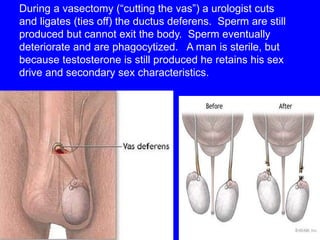 During a vasectomy (“cutting the vas”) a urologist cuts 
and ligates (ties off) the ductus deferens. Sperm are still 
produced but cannot exit the body. Sperm eventually 
deteriorate and are phagocytized. A man is sterile, but 
because testosterone is still produced he retains his sex 
drive and secondary sex characteristics. 
 