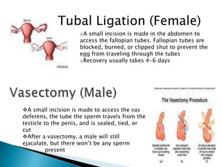 A small incision is made to access the vas
deferens, the tube the sperm travels from the
testicle to the penis, and is sealed, tied, or
cut
After a vasectomy, a male will still
ejaculate, but there won’t be any sperm
present
Tubal Ligation (Female)
oA small incision is made in the abdomen to
access the fallopian tubes. Fallopian tubes are
blocked, burned, or clipped shut to prevent the
egg from traveling through the tubes
oRecovery usually takes 4-6 days
 