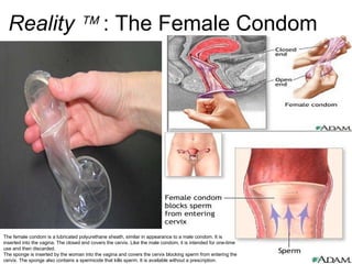 Reality     : The Female Condom The female condom is a lubricated polyurethane sheath, similar in appearance to a male condom. It is inserted into the vagina. The closed end covers the cervix. Like the male condom, it is intended for one-time use and then discarded.  The sponge is inserted by the woman into the vagina and covers the cervix blocking sperm from entering the cervix. The sponge also contains a spermicide that kills sperm. It is available without a prescription.  