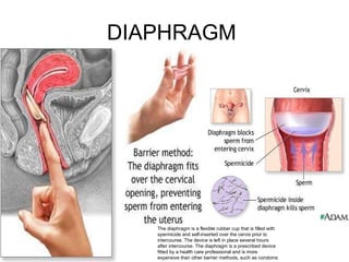 DIAPHRAGM  The diaphragm is a flexible rubber cup that is filled with spermicide and self-inserted over the cervix prior to intercourse. The device is left in place several hours after intercourse. The diaphragm is a prescribed device fitted by a health care professional and is more expensive than other barrier methods, such as condoms  