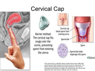 Cervical Cap The cervical cap is a flexible rubber cup-like device that is filled with spermicide and self-inserted over the cervix prior to intercourse. The device is left in place several hours after intercourse. The cap is a prescribed device fitted by a health care professional and can be more expensive than other barrier methods, such as condoms. 