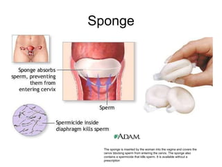 Sponge The sponge is inserted by the woman into the vagina and covers the cervix blocking sperm from entering the cervix. The sponge also contains a spermicide that kills sperm. It is available without a prescription  