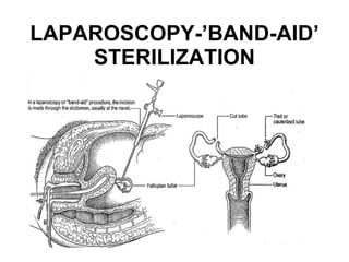 LAPAROSCOPY-’BAND-AID’ STERILIZATION 