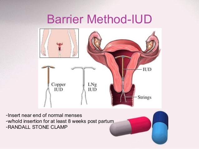 Controlled drug delivery elution mirena ius