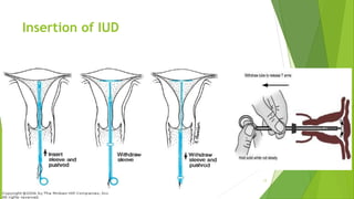 Insertion of IUD
17
 