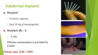 Subdermal Implants
Norplant
 6 sialistic capsules,
 Each 35 mg of levonorgestrel
Norplant (R) – 2
 2 rods
Effective contraception is provided for
5 years
Failure rate: 0.05 / HWY
33
 