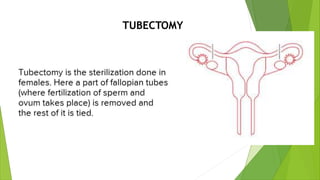 TUBECTOMY
 