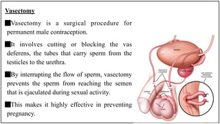 Vasectomy
Vasectomy is a surgical procedure for
permanent male contraception.
It involves cutting or blocking the vas
deferens, the tubes that carry sperm from the
testicles to the urethra.
By interrupting the flow of sperm, vasectomy
prevents the sperm from reaching the semen
that is ejaculated during sexual activity.
This makes it highly effective in preventing
pregnancy.
 