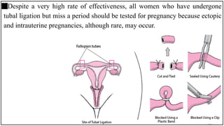 Despite a very high rate of effectiveness, all women who have undergone
tubal ligation but miss a period should be tested for pregnancy because ectopic
and intrauterine pregnancies, although rare, may occur.
 