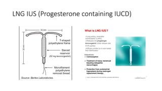 LNG IUS (Progesterone containing IUCD)
 
