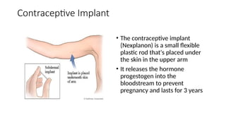 Contraceptive Implant
• The contraceptive implant
(Nexplanon) is a small flexible
plastic rod that's placed under
the skin in the upper arm
• It releases the hormone
progestogen into the
bloodstream to prevent
pregnancy and lasts for 3 years
 
