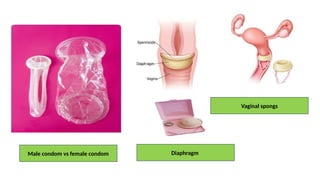 Male condom vs female condom
Vaginal spongs
Diaphragm
 