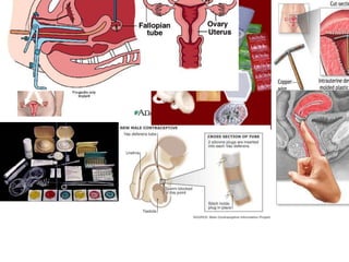 Contraceptive pictures