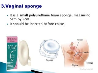  It is a small polyurethane foam sponge, measuring
5cm by 2cm.
 It should be inserted before coitus.
 