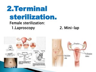 2.Terminal
sterilization.
Female sterilization:
1.Laproscopy 2. Mini-lap
 