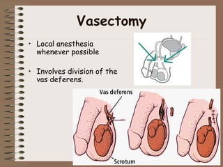 Vasectomy
• Local anesthesia
whenever possible
• Involves division of the
vas deferens.
 