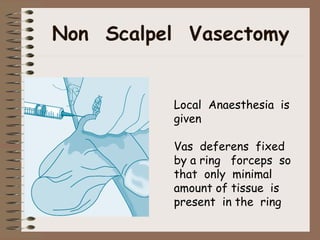 Non Scalpel Vasectomy
Local Anaesthesia is
given
Vas deferens fixed
by a ring forceps so
that only minimal
amount of tissue is
present in the ring
 