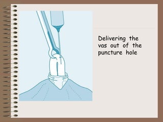 Delivering the
vas out of the
puncture hole
 