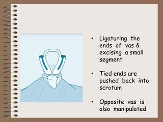 • Ligaturing the
ends of vas &
excising a small
segment
• Tied ends are
pushed back into
scrotum
• Opposite vas is
also manipulated
 