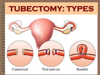 TUBECTOMY: TYPES
 
