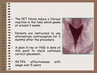 • The PET fibres induce a fibrous
reaction in the tube whick peaks
at around 3 weeks.
• Patients are instructed to use
alternatives contraception for 3
months after the procedure.
• A plain X-ray or HSG is done at
this point to check continued
correct placement.
• 99.74% effectiveness with
usage over 5 years
 