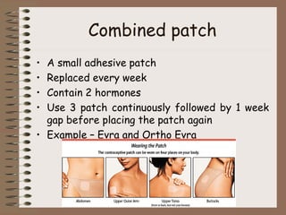 Combined patch
• A small adhesive patch
• Replaced every week
• Contain 2 hormones
• Use 3 patch continuously followed by 1 week
gap before placing the patch again
• Example – Evra and Ortho Evra
 