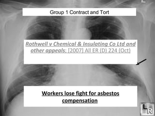 Workers lose fight for asbestos compensation   Rothwell v Chemical & Insulating Co Ltd and other appeals ; [2007] All ER (D) 224 (Oct) Group 1 Contract and Tort 