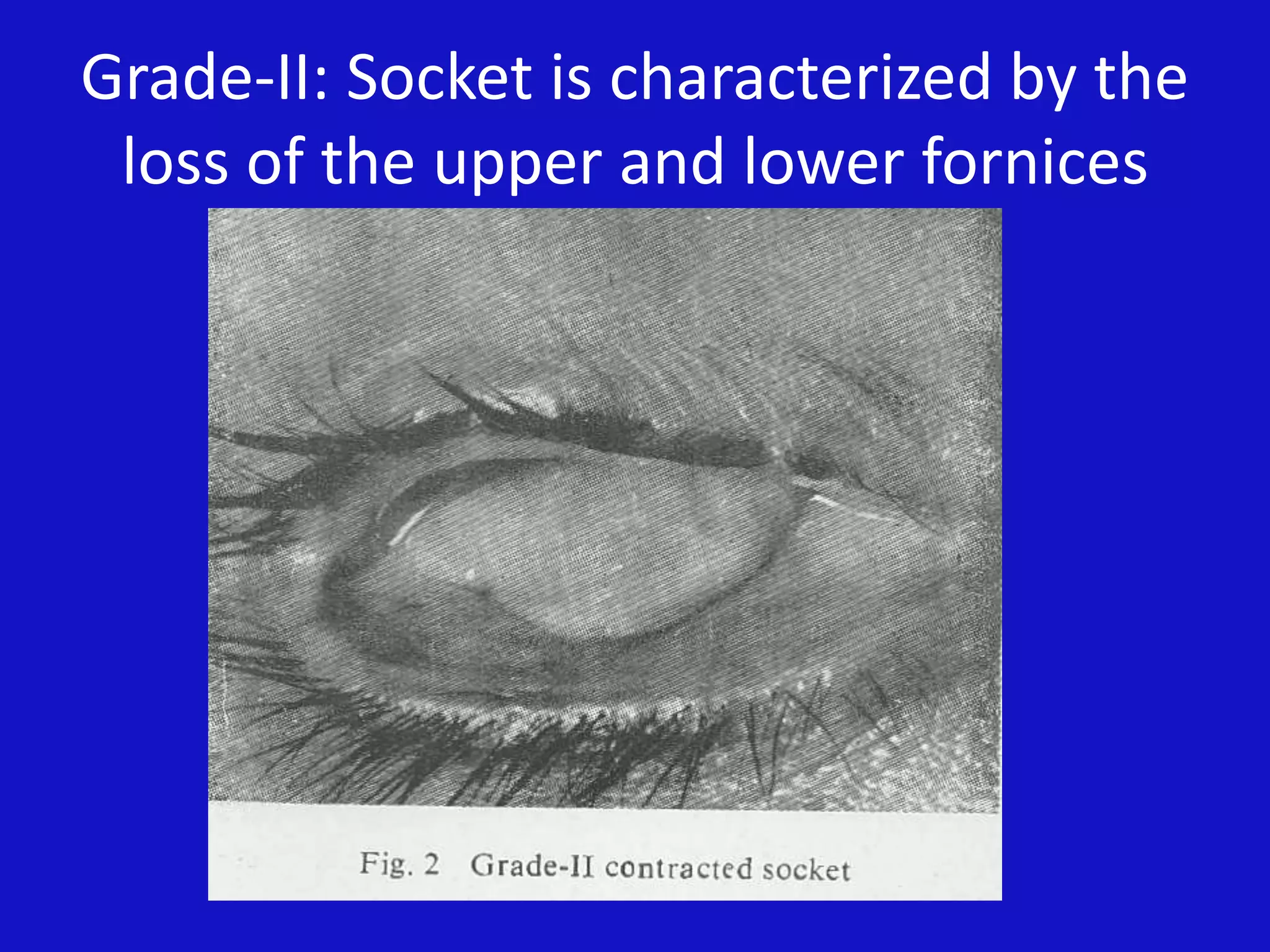 Grade-II: Socket is characterized by the
loss of the upper and lower fornices
 