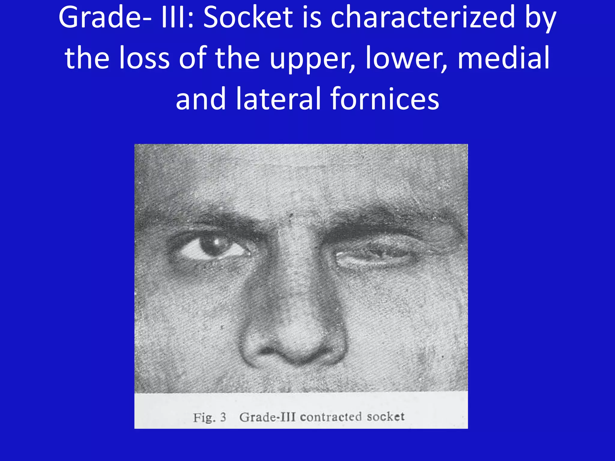 Grade- III: Socket is characterized by
the loss of the upper, lower, medial
and lateral fornices
 