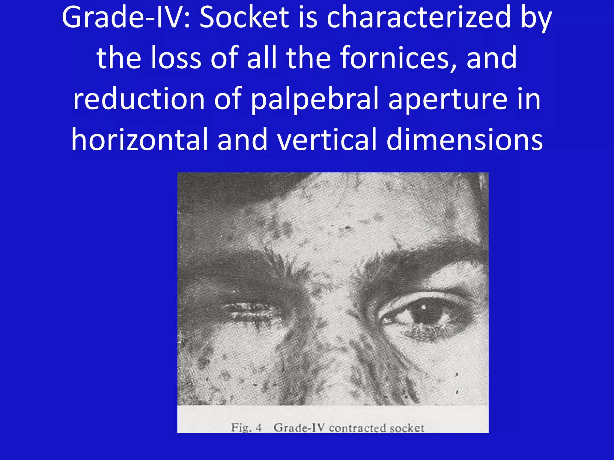 Grade-IV: Socket is characterized by
the loss of all the fornices, and
reduction of palpebral aperture in
horizontal and vertical dimensions
 