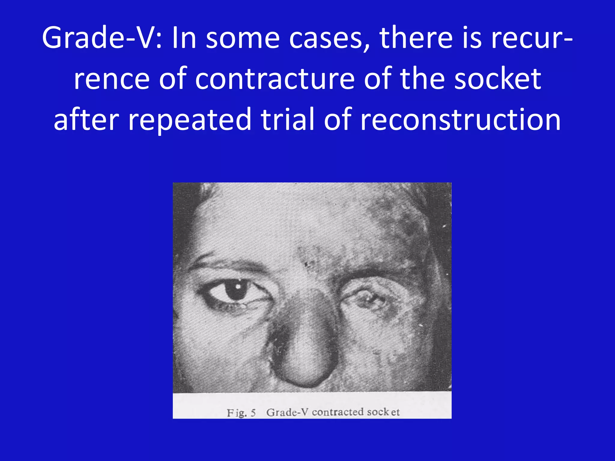 Grade-V: In some cases, there is recur-
rence of contracture of the socket
after repeated trial of reconstruction
 