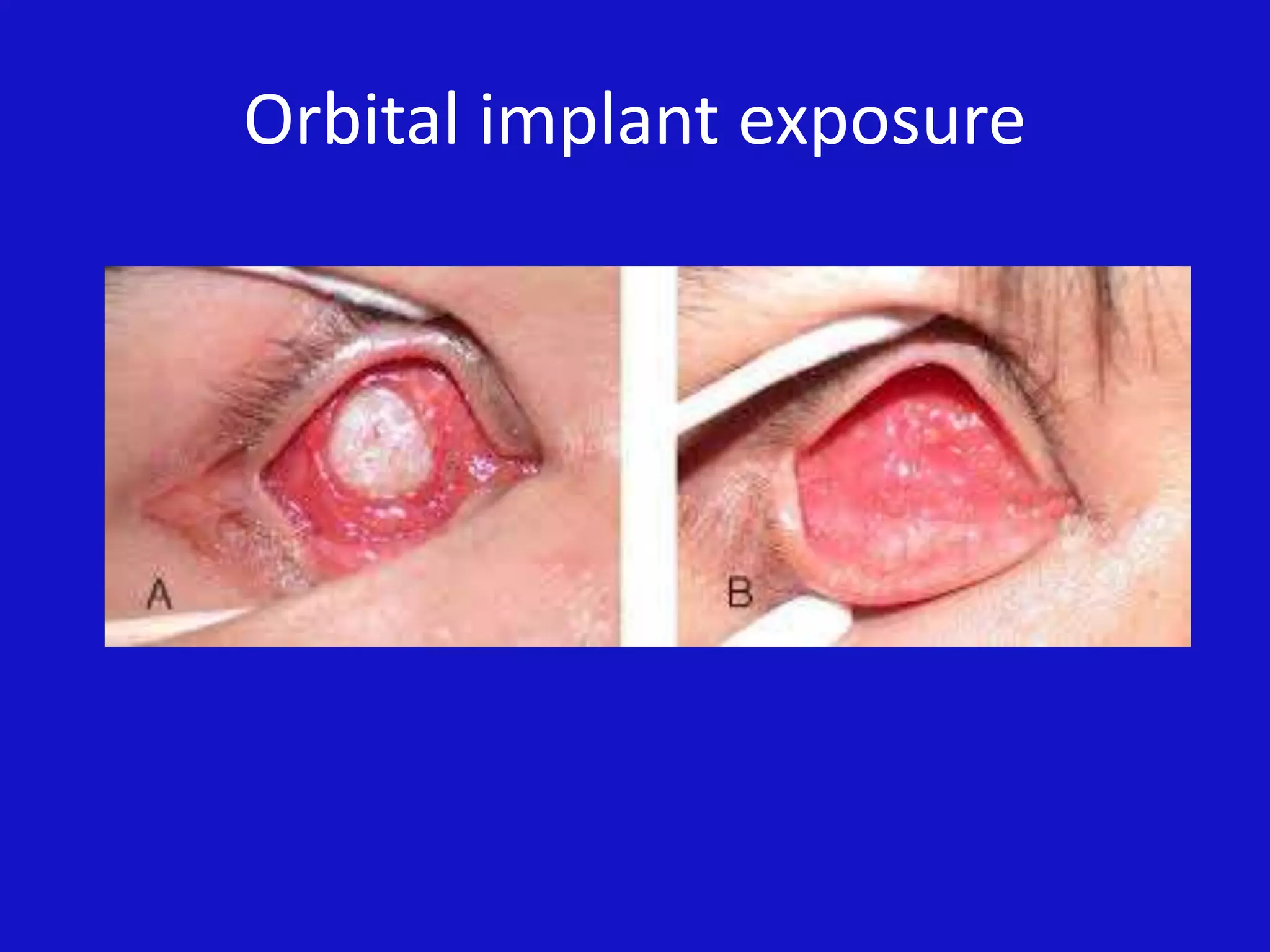 Orbital implant exposure
 