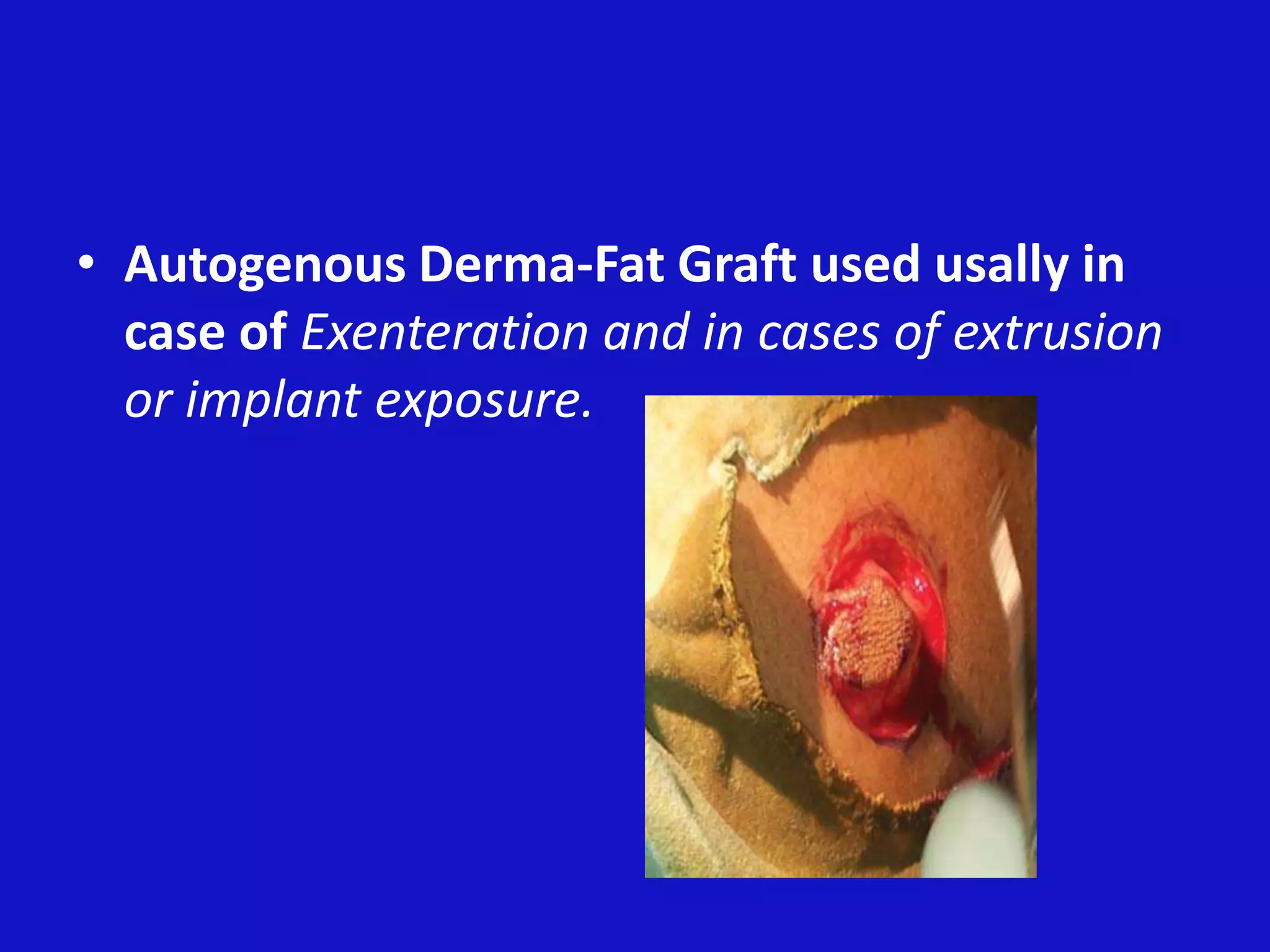 • Autogenous Derma-Fat Graft used usally in
case of Exenteration and in cases of extrusion
or implant exposure.
 