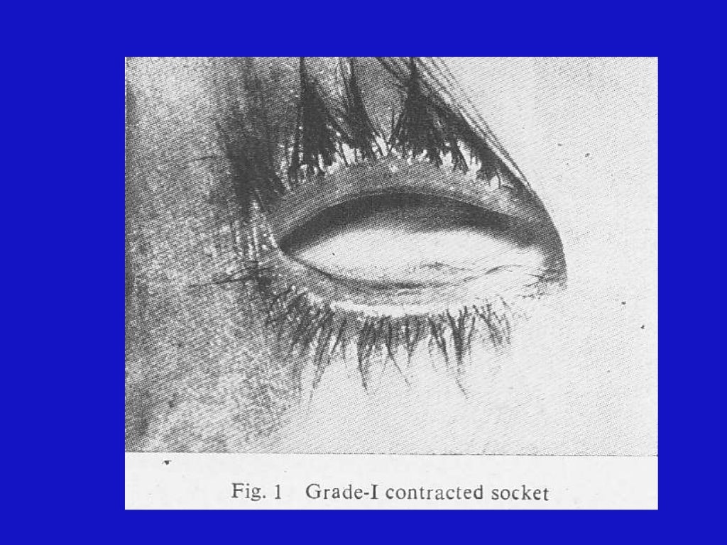 Contracted eye socket reconstruction