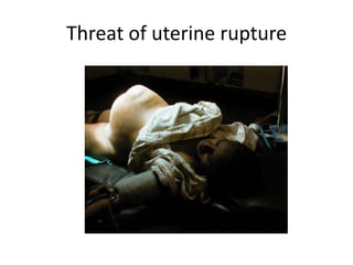 Threat of uterine rupture

 