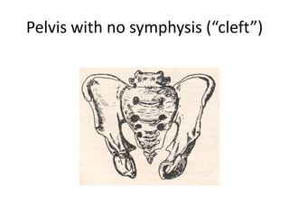 Pelvis with no symphysis (“cleft”)

 