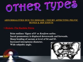 Contracted pelvis | PPT